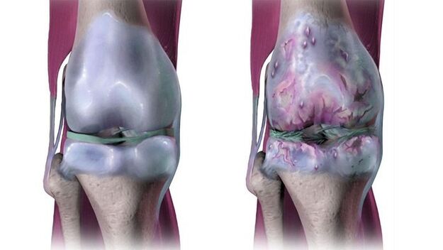 Articulation du genou saine affectée par l'arthrose