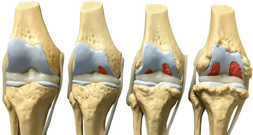 Lésion de l'articulation du genou à différents stades du développement de l'arthrose. 