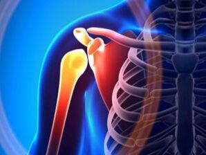 Articulation de l'épaule enflée due à l'arthrose, une maladie chronique du système musculo-squelettique