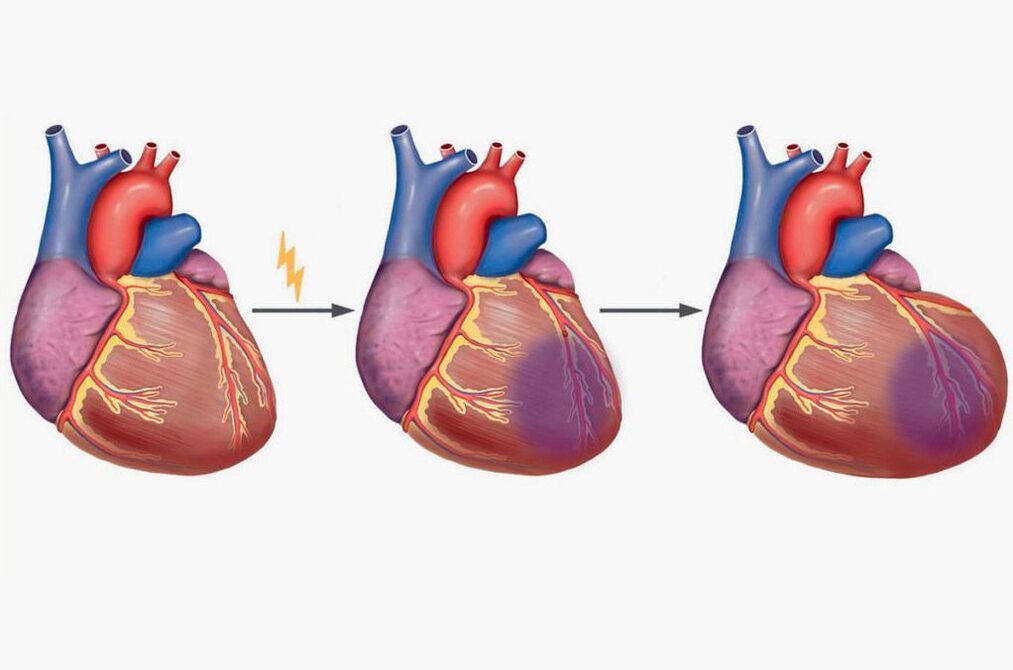 L'infarctus du myocarde provoque des douleurs au niveau des omoplates. 