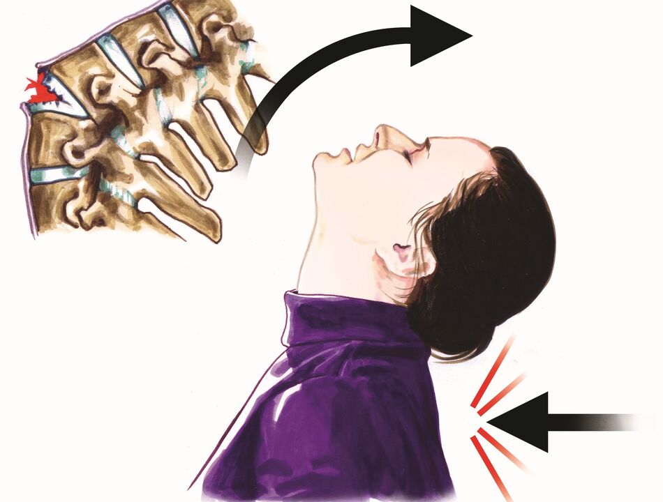 Lésions de la colonne vertébrale comme cause de douleurs au cou.